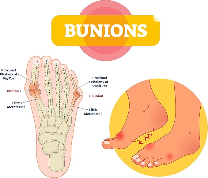 Bunion Protector - Image 2
